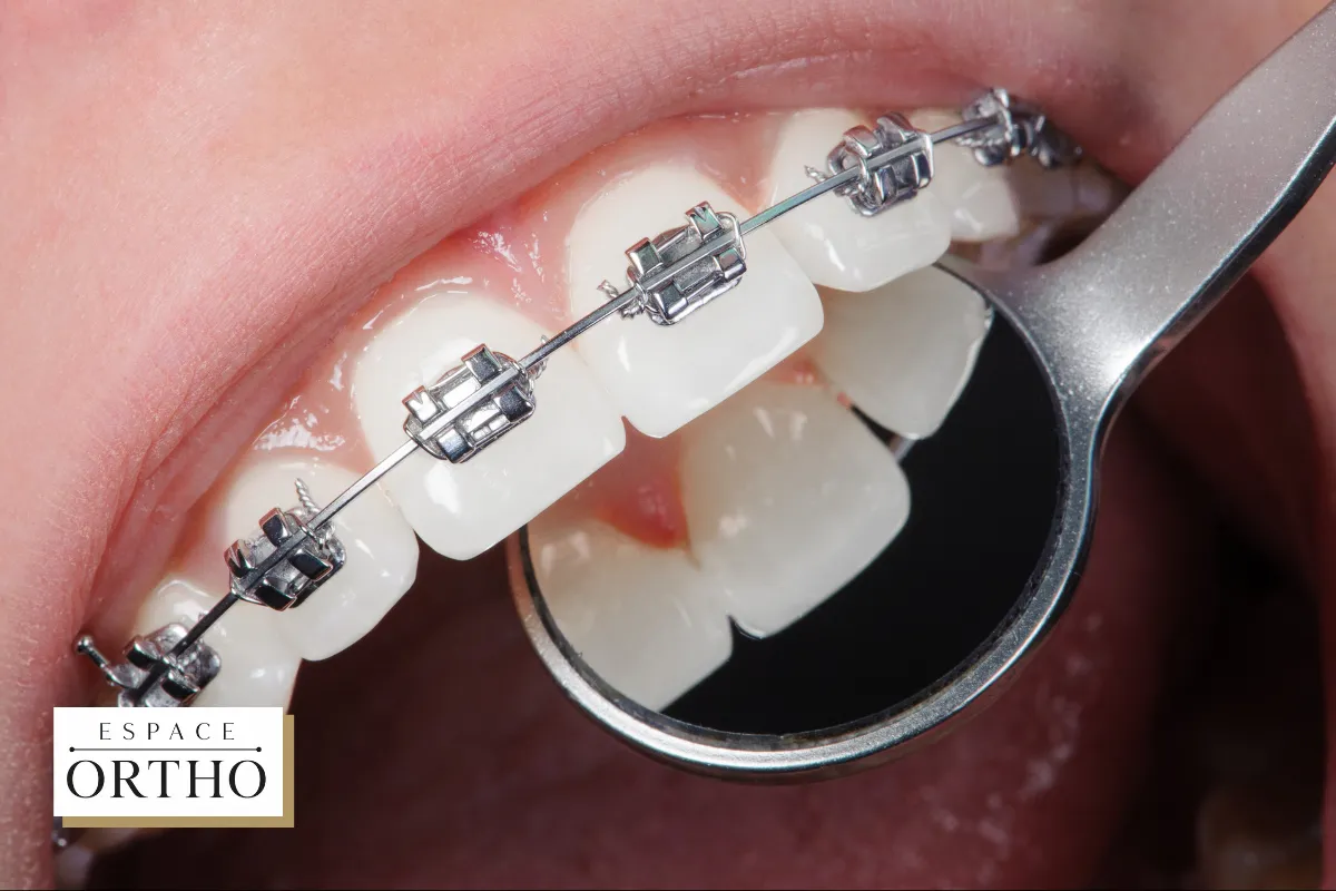 Pourquoi Choisir des Traitements Orthodontiques à Champfleury