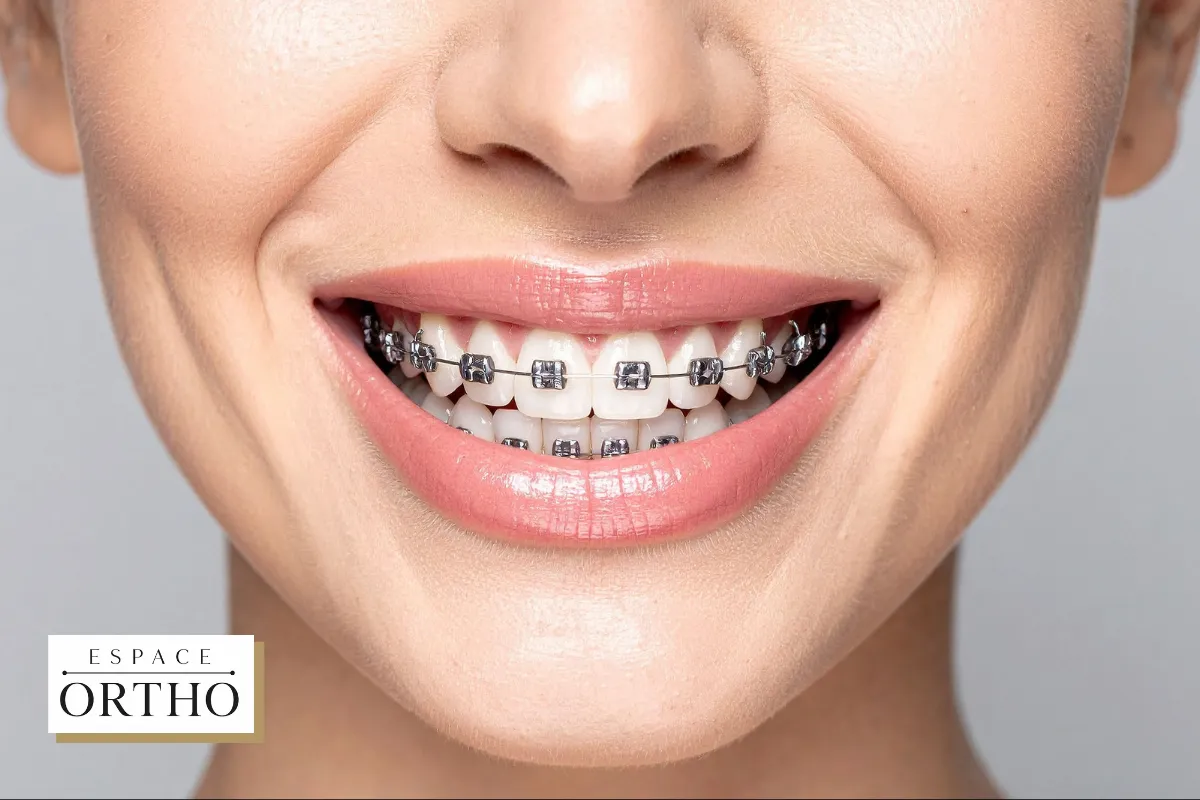Pourquoi l_Orthodontie Adulte est Bénéfique